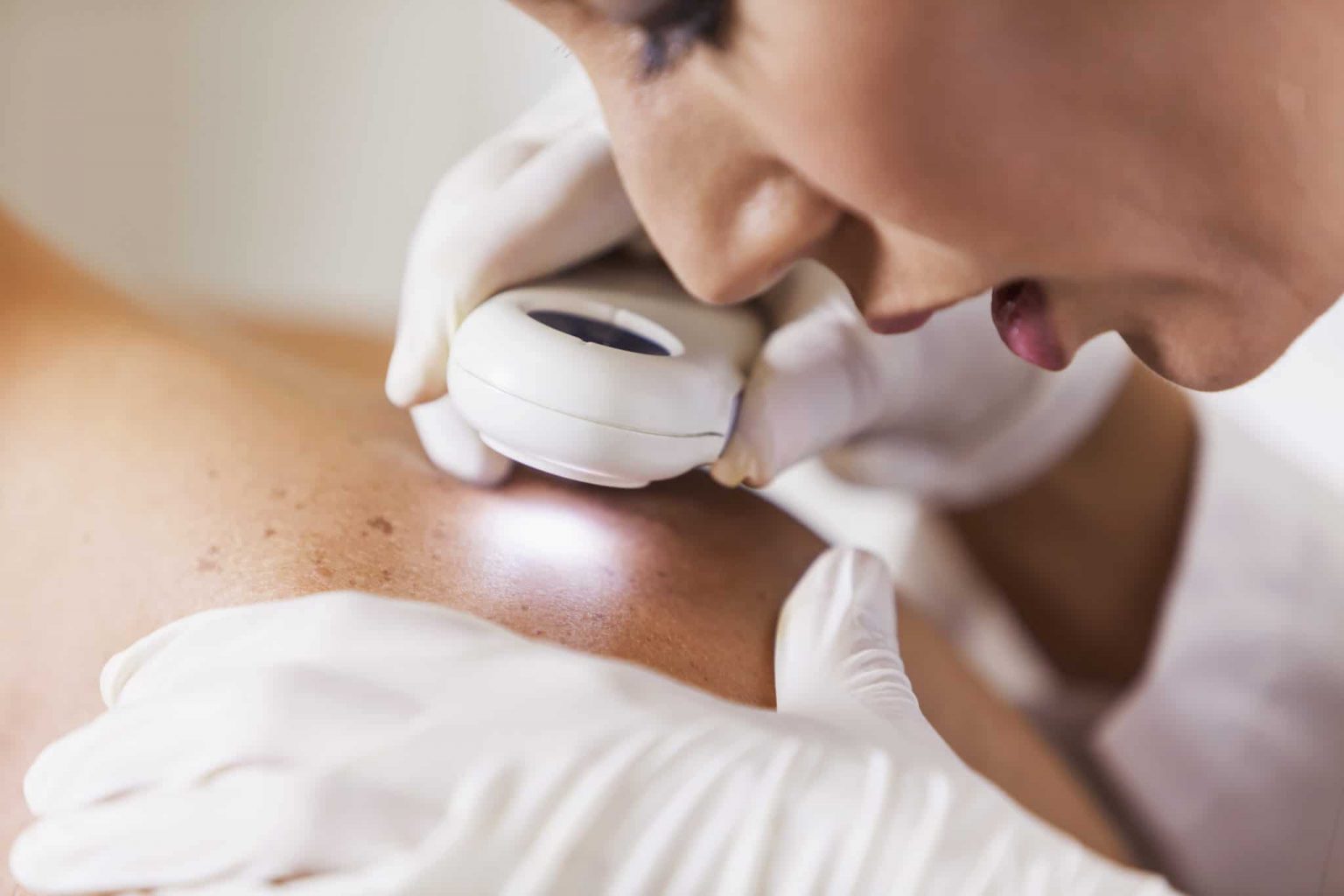 Doctor using a tool to check a patient's skin for skin cancer.