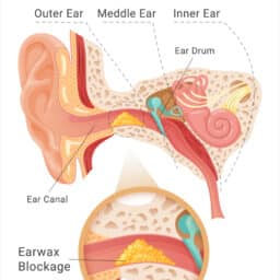 Diagram of earwax blockage