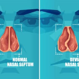 Vector cross section of human face with deviated and normal nasal septum